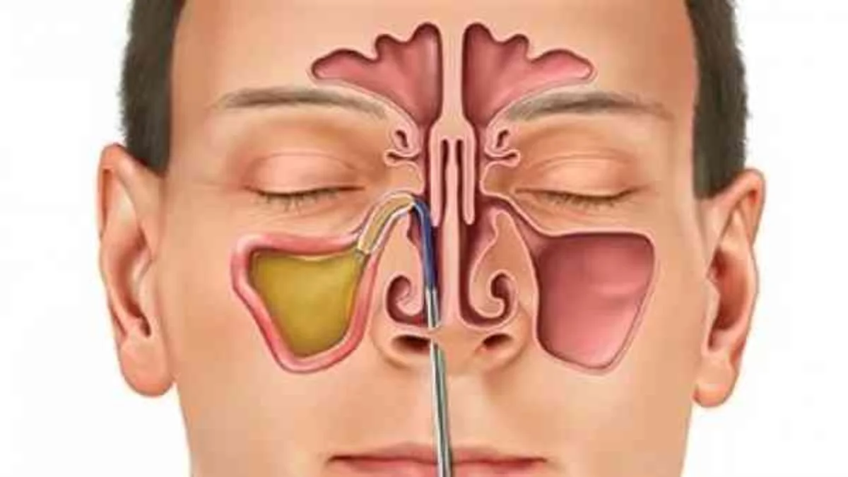 علاج سريع للجيوب الأنفية 1 علاج سريع للجيوب الأنفية
