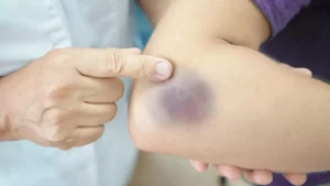 ما هو علاج الكدمات الزرقاء