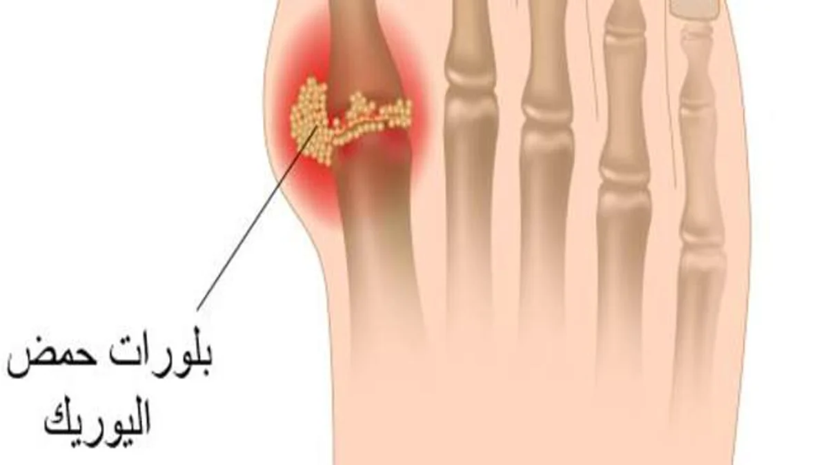 هل مرض النقرس خطير